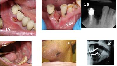 Oral Complications in Cancer Patients–Medication-Related Osteonecrosis of the Jaw (MRONJ)